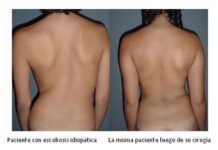 Foto: Ejemplo tras Operación de Escoliosis