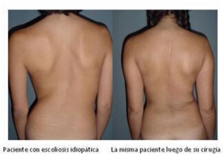 Foto: Ejemplo tras Operación de Escoliosis
