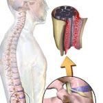 Espondilitis anquilosante