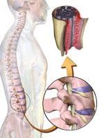 Espondilitis anquilosante