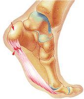 FASCITIS Plantar ¿Cómo Recuperarte?
