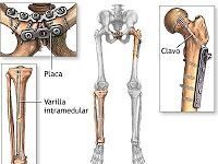 Fijación interna de una fractura de hueso
