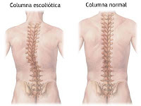 Escoliosis idiopática en el Adolescente