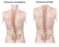 Escoliosis idiopática en el Adolescente