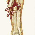 Fractura expuesta 1ª parte.