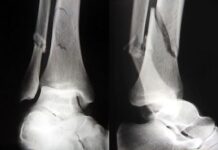 Reparaciones de las fracturas