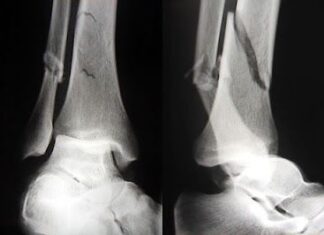 Reparaciones de las fracturas