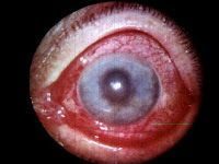 Glaucoma