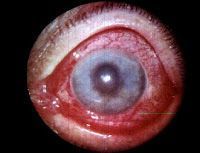 Glaucoma