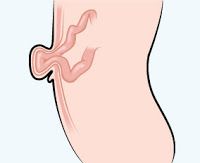 Hernia