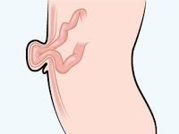 Evaluación de la hernia