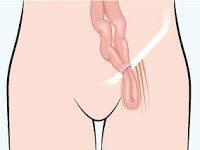 Tipos de hernias