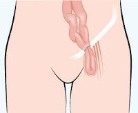 Tipos de hernias