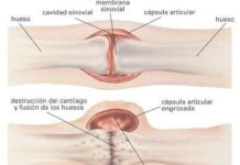 Tratamientos Homeopáticos e inflamaciones – Primera Parte.