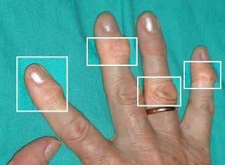 La Artritis – Qué es, Tipos y Videos de Personas que Padecen Artritis