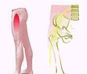 Meralgia parestésica