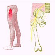 Meralgia parestésica