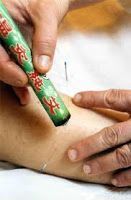 Moxas para el dolor de espalda