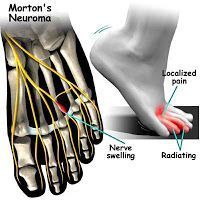 Neuroma de Morton o Metatarsalgia