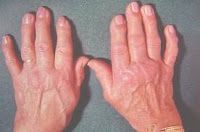 Osteoartritis de las manos