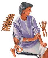 Osteoporosis: Factores de Riesgo y Prevención