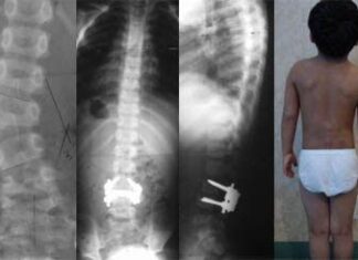 Escoliosis congénita