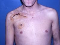 Las lesiones del plexo braquial : 2ª parte