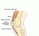 Diagnostico de Rotura del Tendón del Cuádriceps