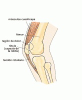 Diagnostico de Rotura del Tendón del Cuádriceps