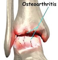 Osteoartritis de rodilla