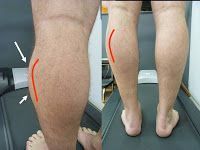 Síndrome compartimental : 1ª parte