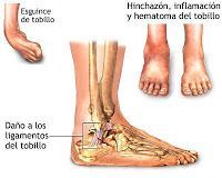Impacto en el tobillo
