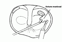Tratamiento de la Rotura de Menisco
