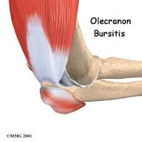 Tratamientos de la bursitis