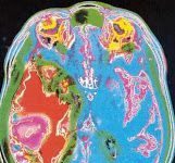 Tumor cerebral