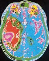 Tumor cerebral