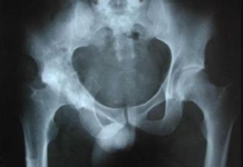 STC (Sinovitis transitoria de la cadera)