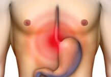 Tips Para Aliviar La Hernia De Hiato Con Remedios Caseros