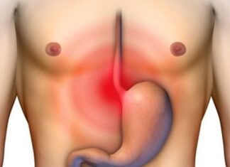 Tips Para Aliviar La Hernia De Hiato Con Remedios Caseros