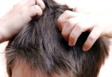 Remedios Naturales Para Combatir La Pediculosis