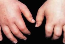 Retención De Líquidos: Sus Causas Y Tratamiento