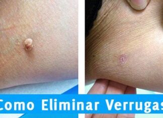 Eliminar VERRUGAS ¡Remedios Naturales y Productos Más Vendidos! como eliminar verrugas