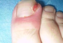 ¿Como Tratar Las Uñas Encarnadas?