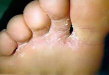 Hongos Pédicos ¿Cómo Prevenirlos?