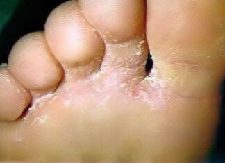 Hongos Pédicos ¿Cómo Prevenirlos?