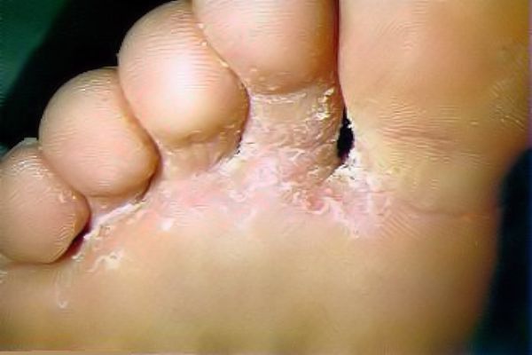 Hongos pedicos