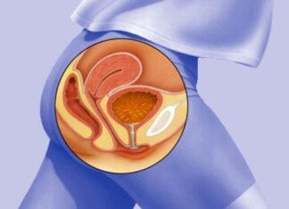 ¿Cómo prevenir infecciones urinarias? Tratamientos naturales para infección de orina