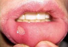 Aftas: ¿Qué Son y Cómo Prevenirlas?