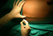 Todo lo que Debes Conocer sobre la EPIDURAL