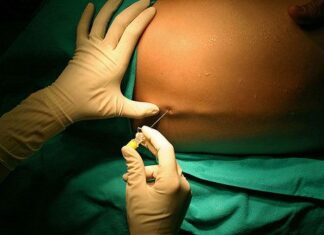 Todo lo que Debes Conocer sobre la EPIDURAL